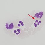 Granulocytic Anaplasmosis